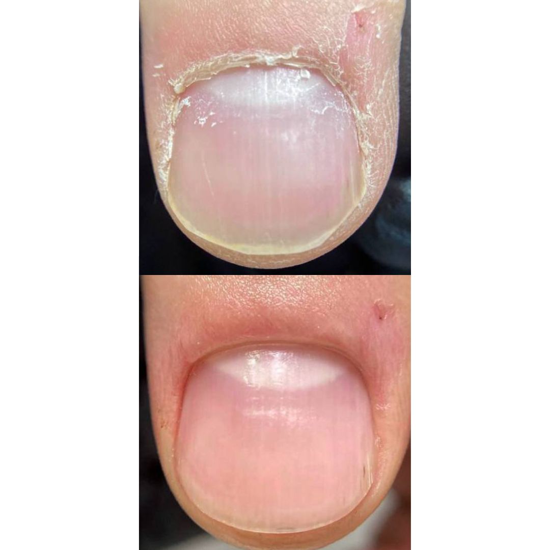 Visible difference before and after gentle blade-free manicure — healthy, polished nail surface achieved in minutes.